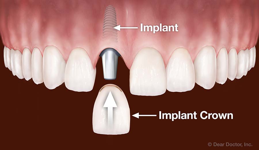 Dental Implants | Kelvin B. Smith, D.D.S., LLC | Baltimore Maryland