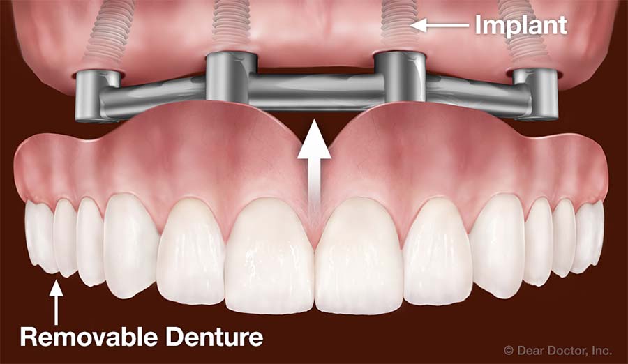 Dental Implants | Kelvin B. Smith, D.D.S., LLC | Baltimore Maryland